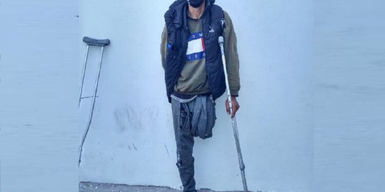 Sufrieron amputaciones en sus piernas y ahora roban en muletas