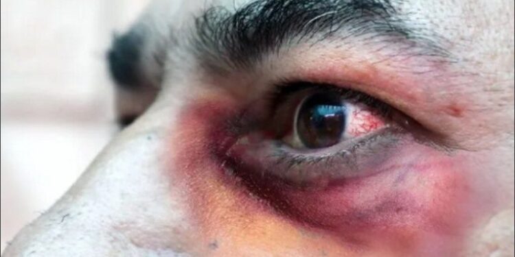 Hongo negro: se registró la primera muerte en Argentina