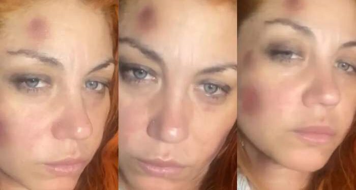 Golpes y moretones: la acusación de violencia de género de una ex Bandana