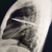 Vivió 8 años sin saber que tenía un cuchillo completo dentro de su pecho