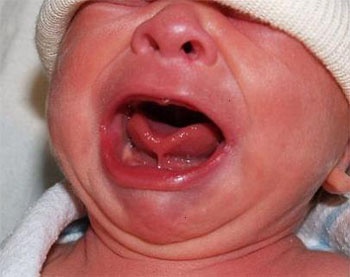 Primera cirugía de tumor en lengua en un bebé que estaba en el vientre de su madre