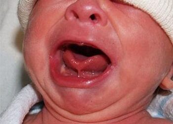 Primera cirugía de tumor en lengua en un bebé que estaba en el vientre de su madre