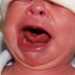 Primera cirugía de tumor en lengua en un bebé que estaba en el vientre de su madre