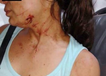 Su ex pareja trató de matarla con un machete