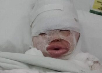 Florencio Varela: una empleada de un restaurante le volcó aceite hirviendo a una nena de 3 años