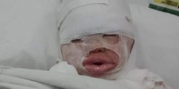 Florencio Varela: una empleada de un restaurante le volcó aceite hirviendo a una nena de 3 años