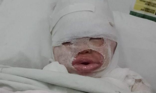 Florencio Varela: una empleada de un restaurante le volcó aceite hirviendo a una nena de 3 años