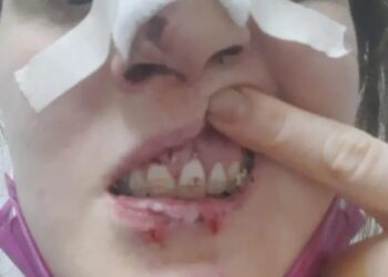 Corrientes: Una mujer sufrió rotura de mandíbula tras un intento de robo