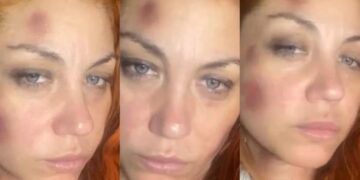Golpes y moretones: la acusación de violencia de género de una ex Bandana