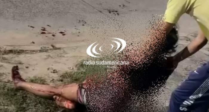 Terrible accidente entre dos motos provocó que una joven pierda el brazo