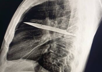 Vivió 8 años sin saber que tenía un cuchillo completo dentro de su pecho