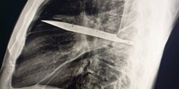 Vivió 8 años sin saber que tenía un cuchillo completo dentro de su pecho