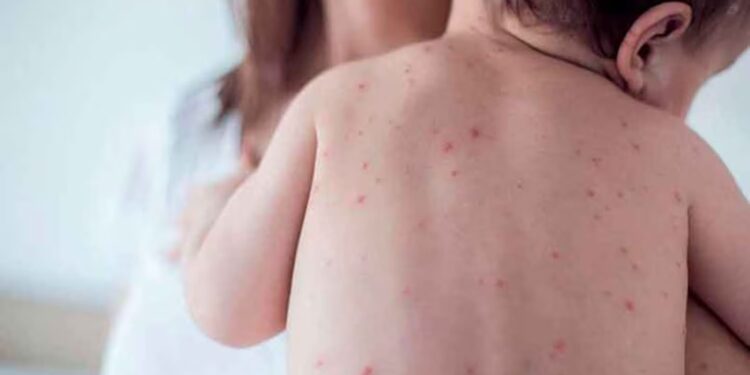 El Ministerio de Salud detectó un caso de sarampión en Entre Ríos y reactivó la alerta a nivel nacional
